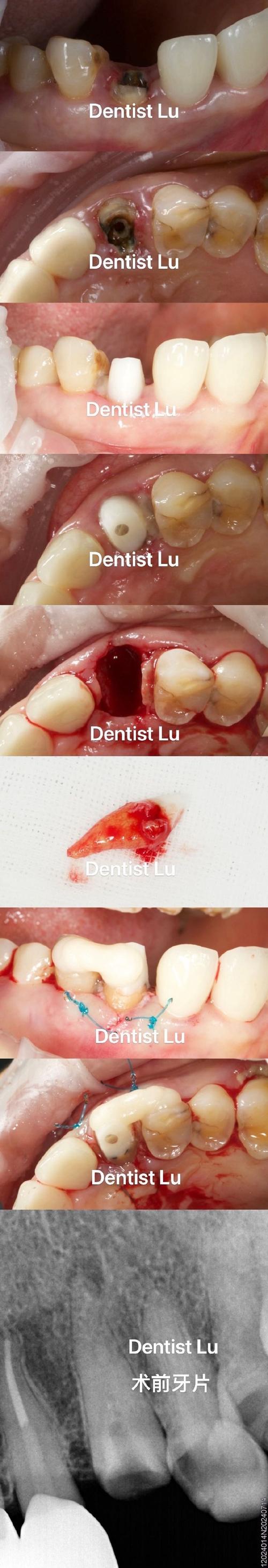 正畸结扎丝划伤牙釉质是操作失误还是材料问题?患者该如何早期发现并科学预防此类损伤?-图3 正畸结扎丝划伤牙釉质是操作失误还是材料问题?患者该如何早期发现并科学预防此类损伤?-图3