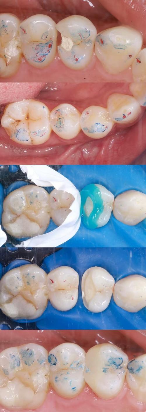 正畸结扎丝划伤牙釉质是操作失误还是材料问题?患者该如何早期发现并科学预防此类损伤?-图1 正畸结扎丝划伤牙釉质是操作失误还是材料问题?患者该如何早期发现并科学预防此类损伤?-图1