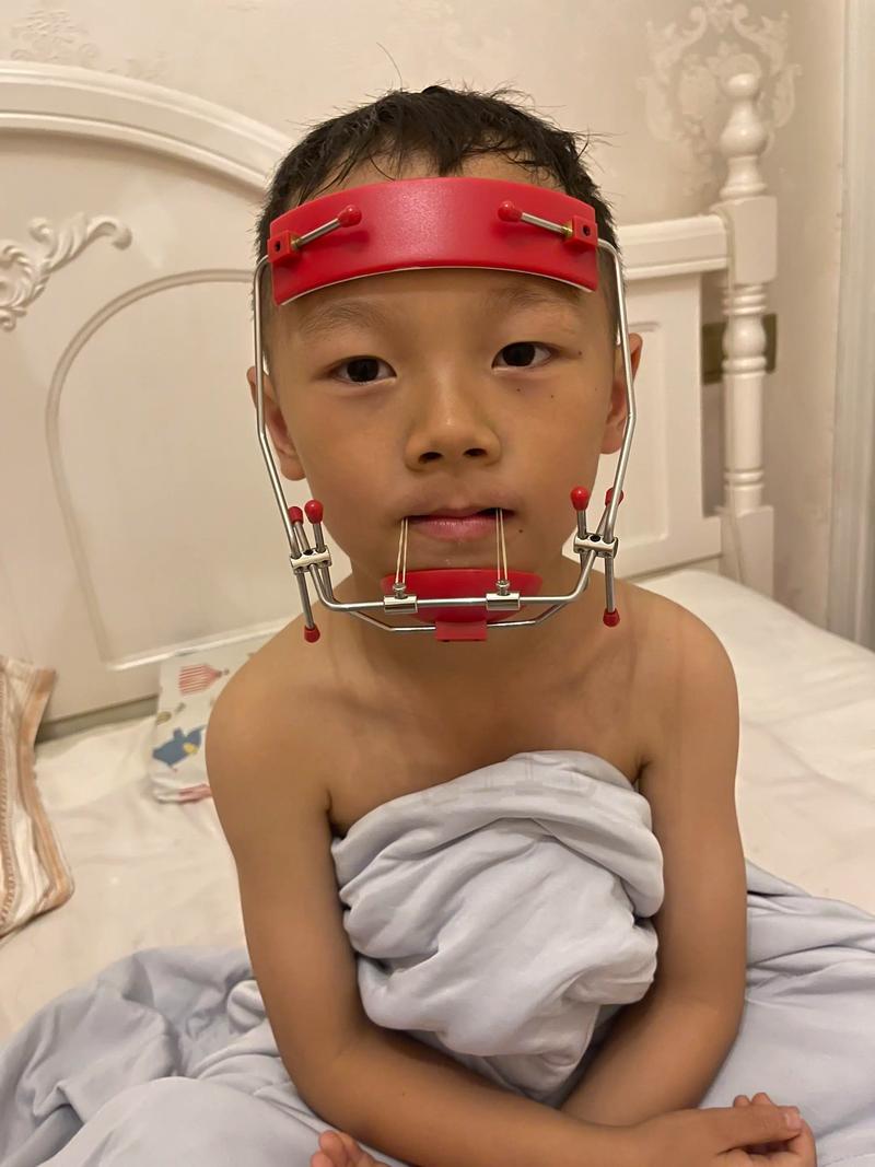 宝宝反颌(地包天)怎么纠正?有哪些安全有效的干预方法?最佳治疗时机是什么时候?-图1 宝宝反颌(地包天)怎么纠正?有哪些安全有效的干预方法?最佳治疗时机是什么时候?-图1