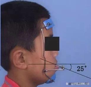 宝宝反颌(地包天)怎么纠正?有哪些安全有效的干预方法?最佳治疗时机是什么时候?-图2 宝宝反颌(地包天)怎么纠正?有哪些安全有效的干预方法?最佳治疗时机是什么时候?-图2