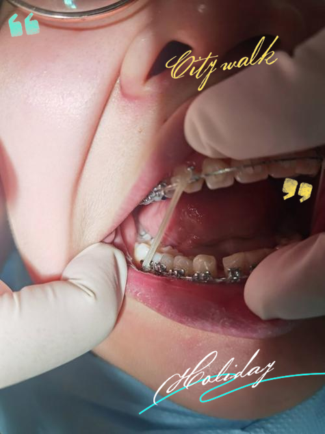 正畸陶瓷牙套 优缺点-图3