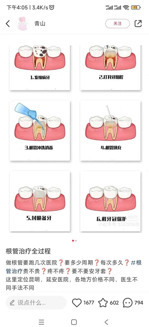根管消毒的方法有哪些？不同消毒方式的优缺点及适用情况是怎样的？-图3