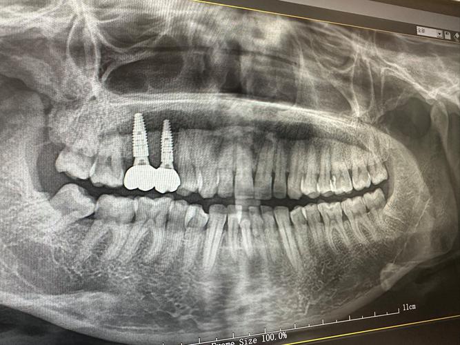 种牙前拍X光检查,辐射对身体有影响吗?会影响种牙效果和后期使用吗?-图1 种牙前拍X光检查,辐射对身体有影响吗?会影响种牙效果和后期使用吗?-图1