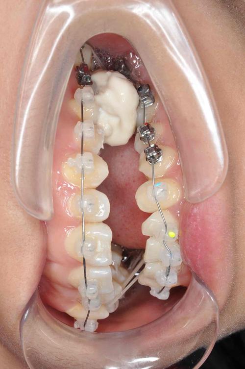 后牙锁颌有哪些常见矫正方法？不同方法的适用人群和矫正效果有何差异？-图2