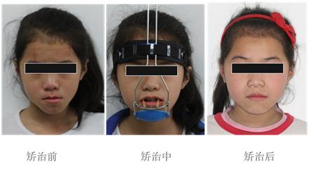 矫正兜齿的民间土方法真的有效吗?效果、安全性和科学性究竟如何?-图2 矫正兜齿的民间土方法真的有效吗?效果、安全性和科学性究竟如何?-图2