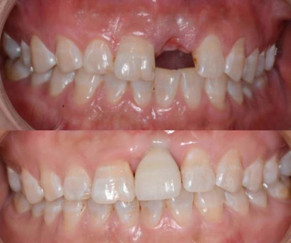 年青人镶牙与种牙该如何选？从美观、耐用、成本到长期效果，哪种方案更契合年轻人的牙齿健康与生活需求？-图3