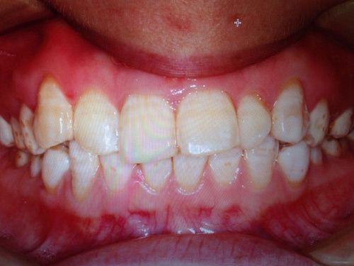 正畸前几天舌头特别苦-图2