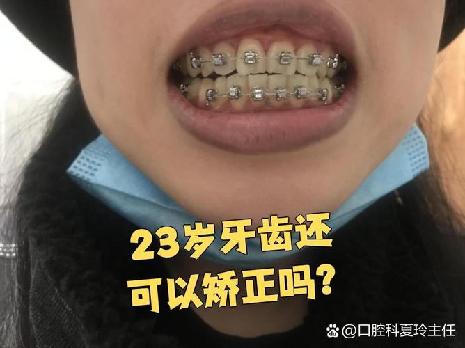 正畸时尖牙为何拉不动?原因大揭秘-图2 正畸时尖牙为何拉不动?原因大揭秘-图2