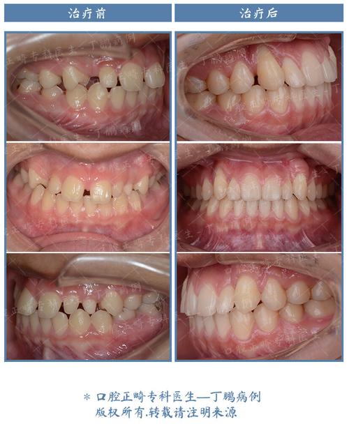 正畸时尖牙为何拉不动?原因大揭秘-图1 正畸时尖牙为何拉不动?原因大揭秘-图1