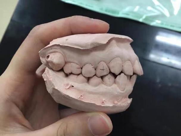 正畸过山车效应，矫正过程为何像坐过山车？-图3