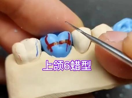 固定蜡型制作的具体步骤和方法是什么？-图2