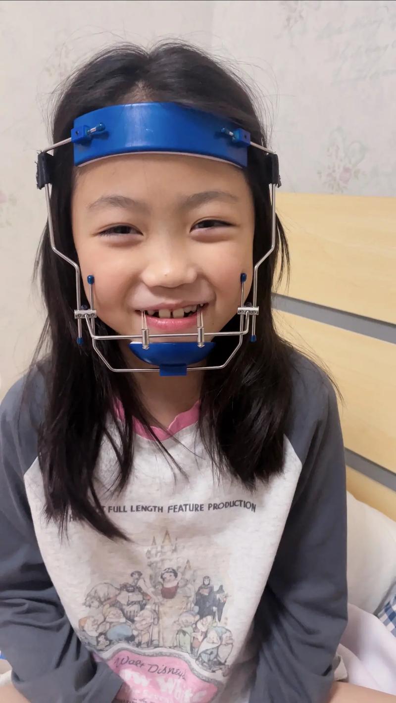 乳牙反颌锻炼方法-图1