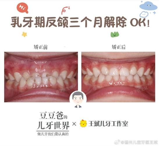乳牙反颌锻炼方法-图2