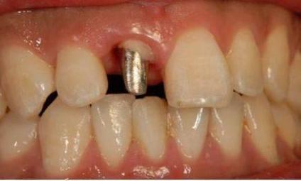 种的牙桩上发现小孔，这是怎么回事？需要担心吗？-图2