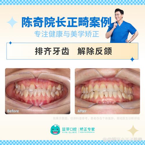 上海正畸医院科瓦矫正安全吗？如何保障？-图2