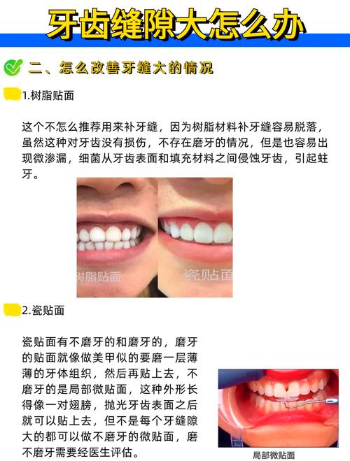 牙缝大如何修复？有哪些科学有效的方法？-图2