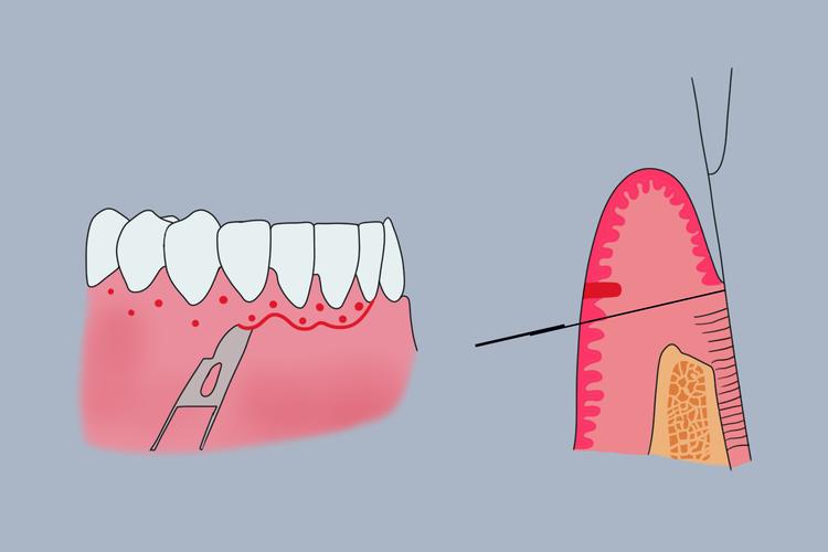 牙周手术缝合方法的选择与操作要点是什么?-图1 牙周手术缝合方法的选择与操作要点是什么?-图1