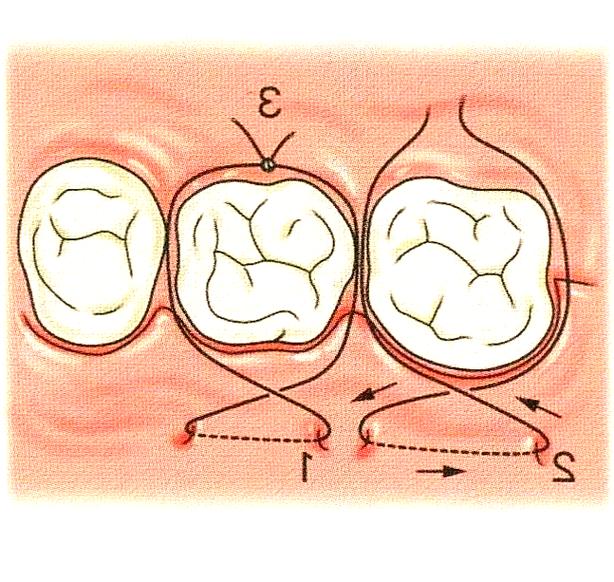 牙周手术缝合方法的选择与操作要点是什么?-图2 牙周手术缝合方法的选择与操作要点是什么?-图2