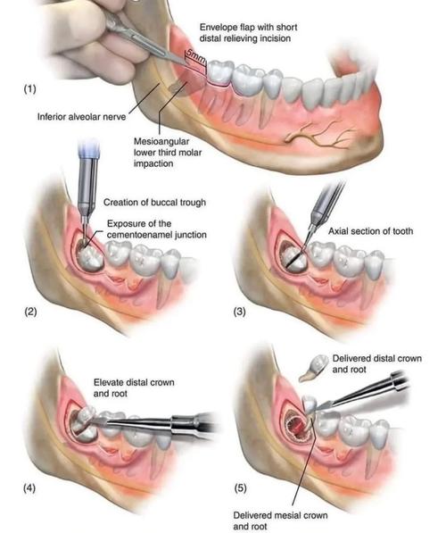 拔智齿后如何快速消肿？实用方法有哪些？-图1
