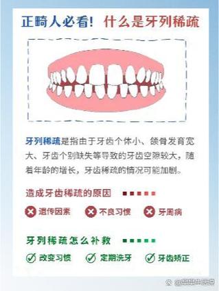 上牙稀疏该怎么办?有哪些有效治疗方法?-图1 上牙稀疏该怎么办?有哪些有效治疗方法?-图1