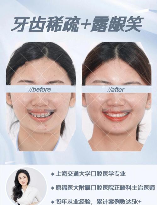 上牙稀疏该怎么办?有哪些有效治疗方法?-图2 上牙稀疏该怎么办?有哪些有效治疗方法?-图2