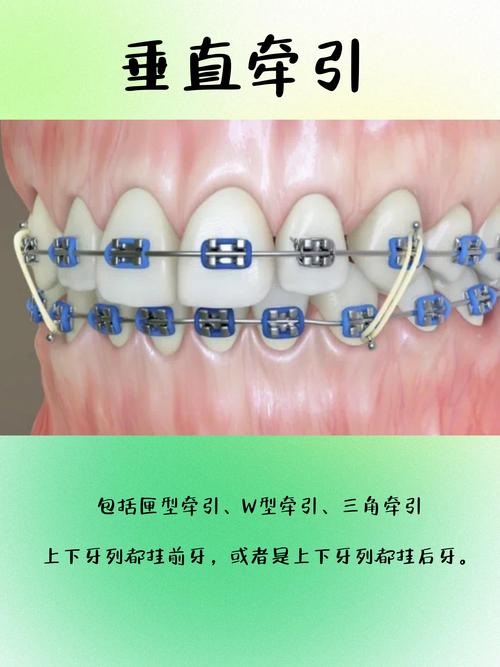 正畸带环取下方法有哪些？如何正确操作？-图3