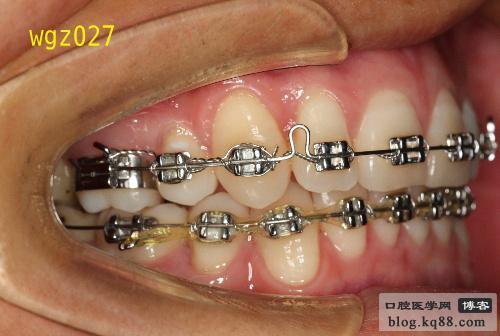 正畸带环取下方法有哪些？如何正确操作？-图2