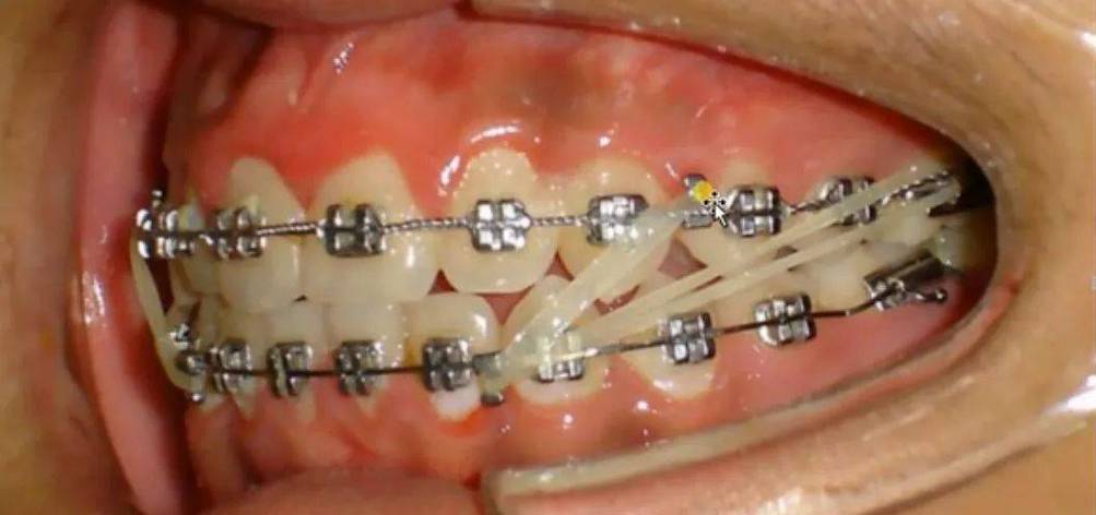 正畸牵引真能缩短下颌骨?效果如何实现?-图3 正畸牵引真能缩短下颌骨?效果如何实现?-图3