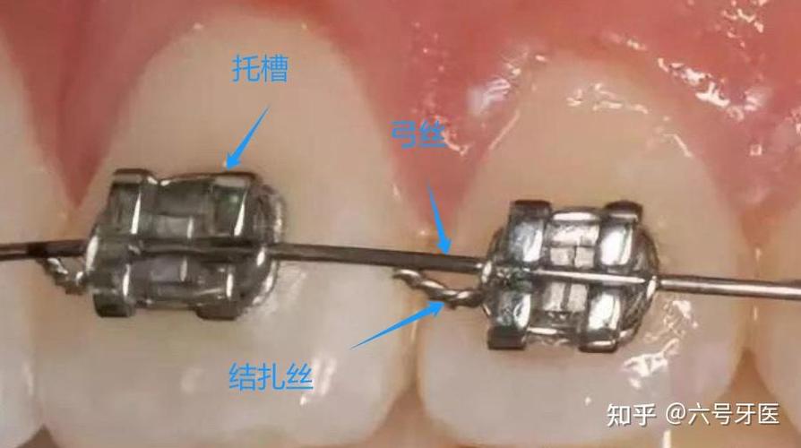正畸托槽粘接位置数值如何规范把控?-图2 正畸托槽粘接位置数值如何规范把控?-图2