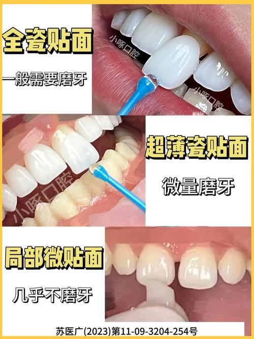 临时牙贴面的制作方法是什么?步骤有哪些?-图1 临时牙贴面的制作方法是什么?步骤有哪些?-图1