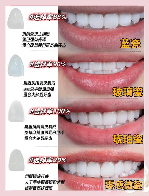 临时牙贴面的制作方法是什么?步骤有哪些?-图3 临时牙贴面的制作方法是什么?步骤有哪些?-图3