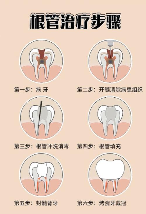 牙齿根尖治疗方法如何有效选择?-图2 牙齿根尖治疗方法如何有效选择?-图2