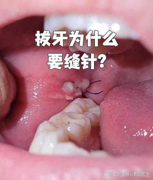 拔牙创处理的关键步骤和方法有哪些？-图3