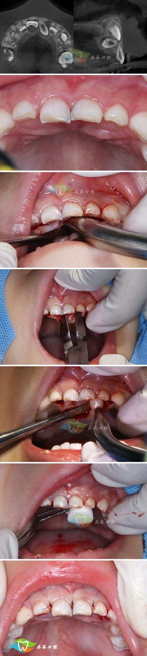 一个牙钉种两棵牙？这种种植技术可行吗？-图1