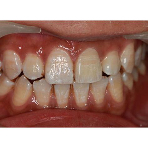 四环素牙种牙与镶牙哪种修复方式更合适？-图2