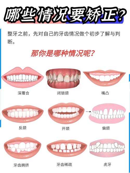 隐形牙套有多少种？不同品牌各有哪些类型？-图1