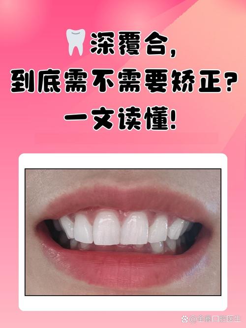 咬合深覆正畸遭拒，医生为何持反对态度？-图1
