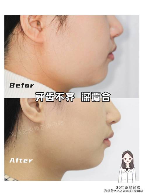 咬合深覆正畸遭拒，医生为何持反对态度？-图3