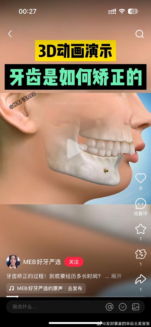 咬合深覆正畸遭拒，医生为何持反对态度？-图2