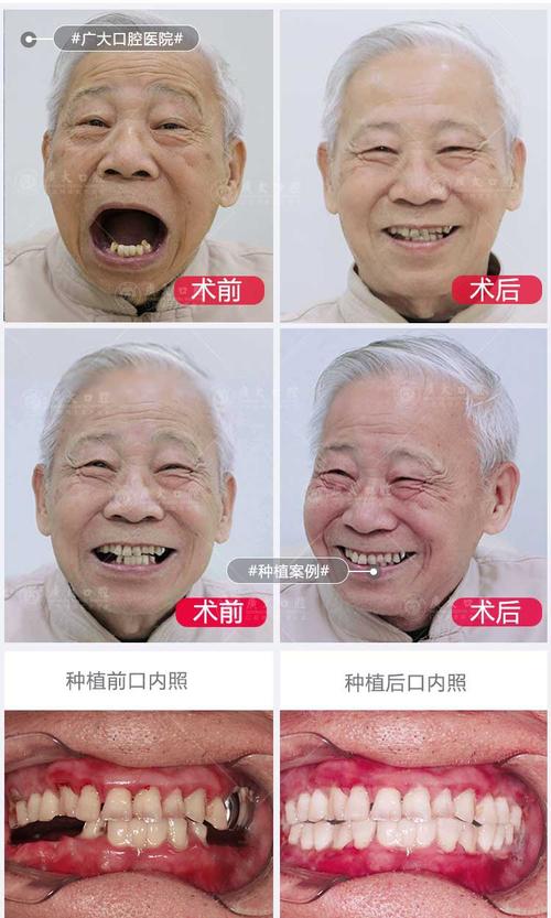 广州公益种牙假的消息是否属实？是真的吗？-图1