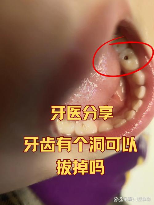 牙洞最佳补救方法是什么?哪种最有效?-图2 牙洞最佳补救方法是什么?哪种最有效?-图2