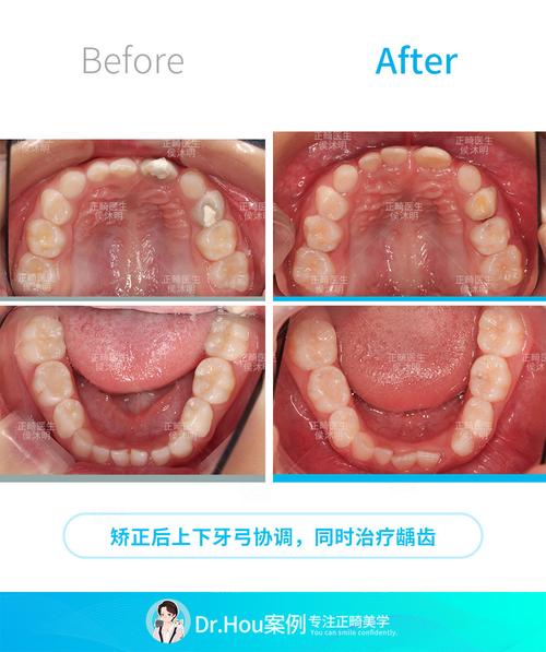 儿童前牙反颌正畸的最佳矫治时机是什么时候?-图1 儿童前牙反颌正畸的最佳矫治时机是什么时候?-图1