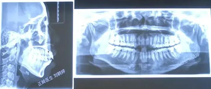 正畸过山车具体指正畸过程中的什么？-图1
