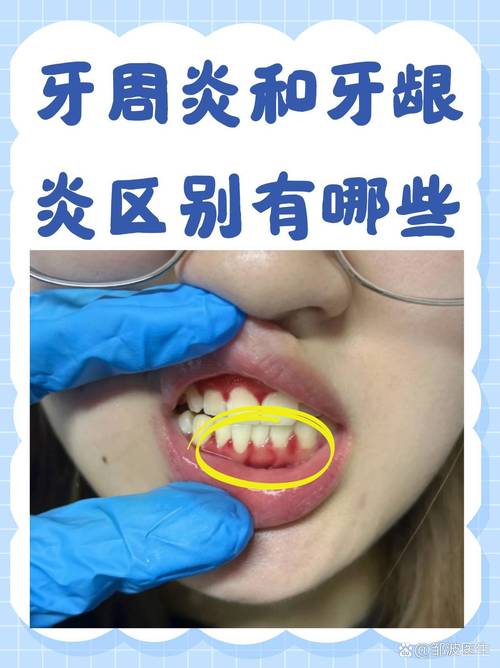 牙周炎患者做正畸治疗会有什么后果?-图1 牙周炎患者做正畸治疗会有什么后果?-图1