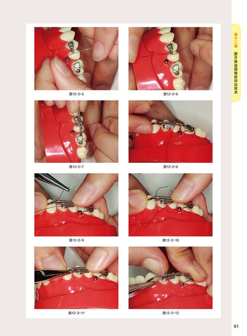 正畸套装使用方法，新手如何正确操作？-图2