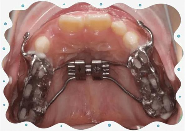 正畸拔牙后上下颌牵引有何必要性？-图3