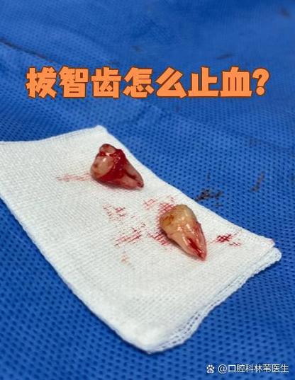 拔牙后一直流血？快速止血方法有哪些？-图2