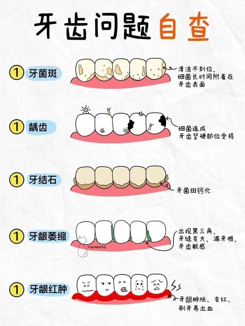 戴牙套后,口腔卫生该如何有效清洁护理?-图3 戴牙套后,口腔卫生该如何有效清洁护理?-图3