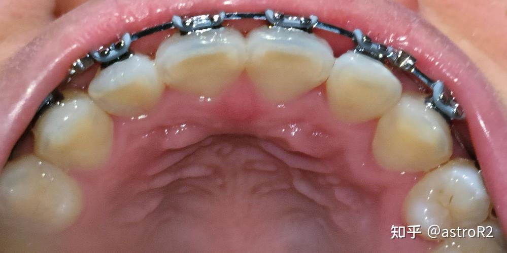 北大口腔正畸失败案例,问题究竟出在哪?-图1 北大口腔正畸失败案例,问题究竟出在哪?-图1