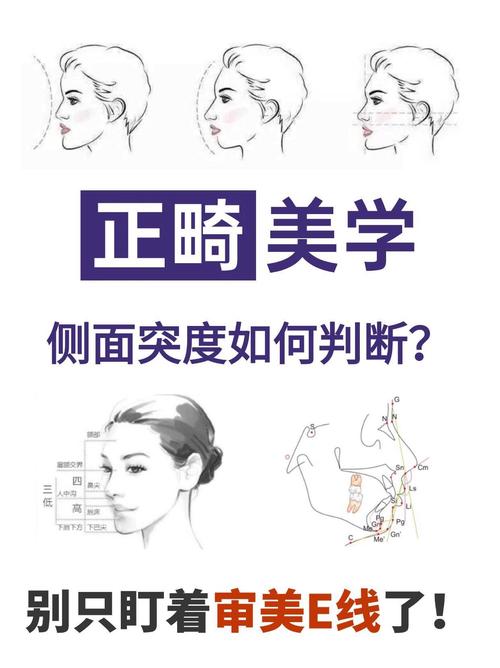 正畸治疗中调整中线位置的有效方法有哪些?-图3 正畸治疗中调整中线位置的有效方法有哪些?-图3